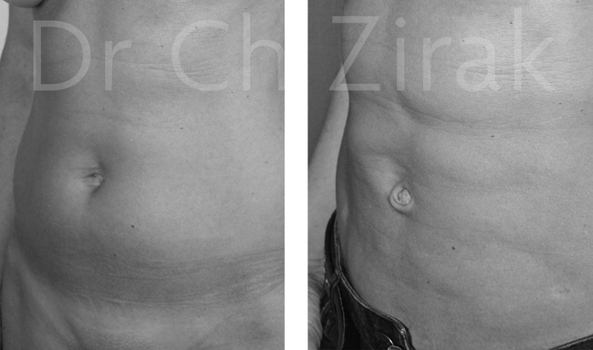 Lipoaspiration haute définition