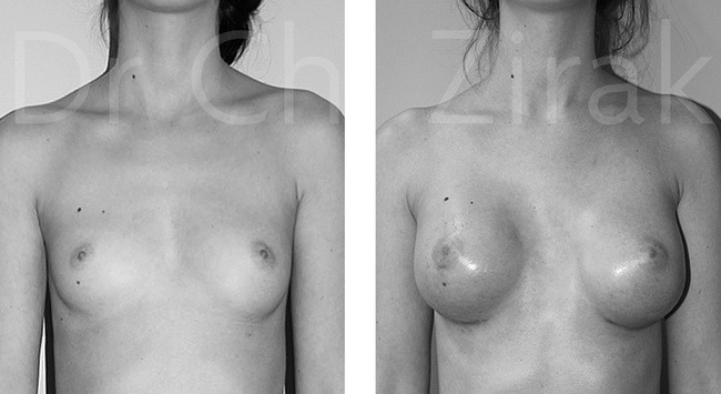 Reconstruction mammaire par prothèses 