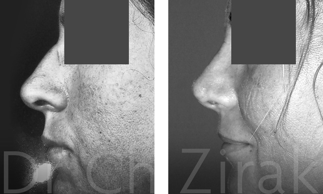 Chirurgie du nez – Septorhinoplastie