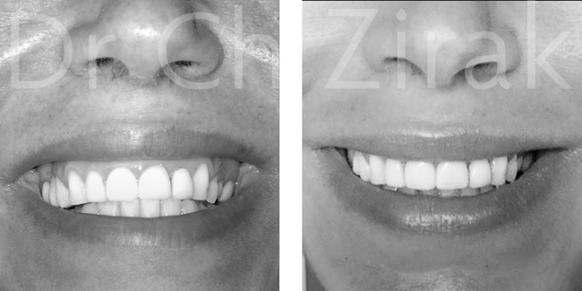 La toxine botulinique (Botox©)