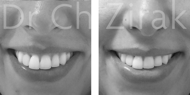 La toxine botulinique (Botox©)